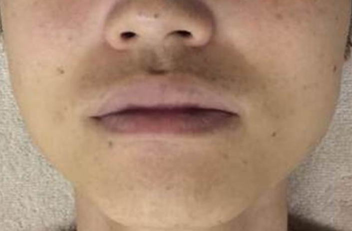 口周りヒゲ脱毛効果 脱毛後