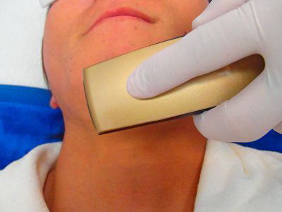 あごひげ脱毛Step4