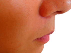 あごひげ脱毛After