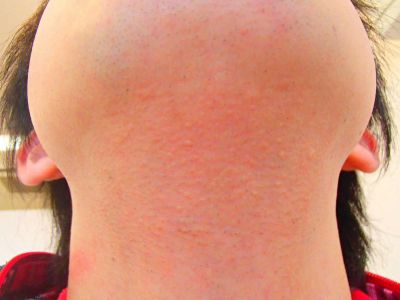 うなじ脱毛効果 脱毛後