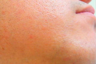 あごひげ脱毛After