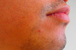 あごひげ脱毛前