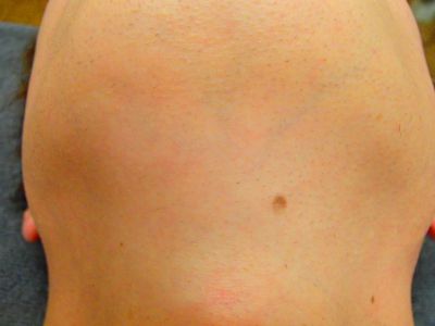 あご下ひげ脱毛後